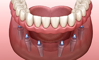 diagram of dental implants that were affordable