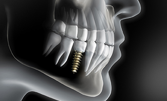 Diagram of dental implants in Massapequa Park