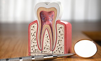 A model of a tooth needing a root canal