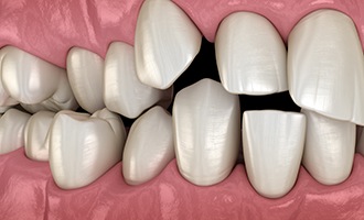 Illustration of crowded teeth