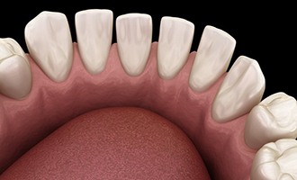 Illustration of teeth with gaps