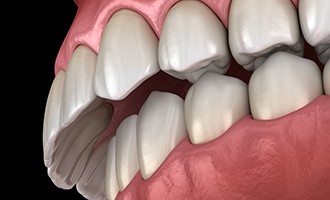 Illustration of teeth with overbite
