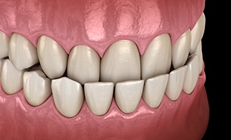 Illustration of teeth with underbite