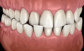 Illustration of teeth with crossbite