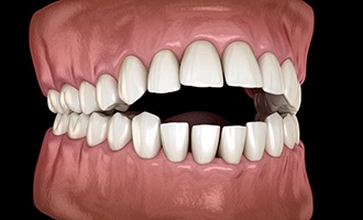 Illustration of teeth with open bite