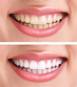 Before-and-after closeup of a smile that's been whitened