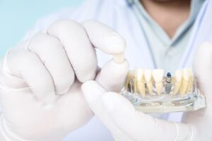 Dentist holding sample dental implant and clear model mandible with white gloves