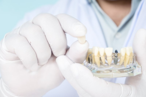 Dentist holding a model dental implant